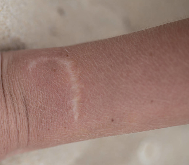 伤口增生怎么彻底治愈,伤口增生怎么能消除