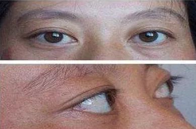 甲亢引起的眼球突出多久能恢复,甲亢导致眼球突出四五年了