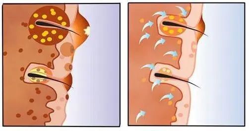 前胸后背长痘痘是毛囊炎吗,前胸后背很容易长痘痘中医治疗