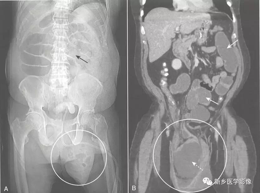 辨识肠梗阻,肠梗阻死亡前兆