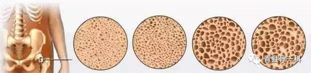 小孩骨密度低是什么原因,骨密度高和骨密度低有什么区别