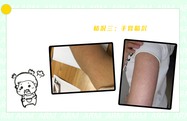 夏天胳膊粗怎么穿吊带才好,鸡皮肤非常严重怎么穿吊带