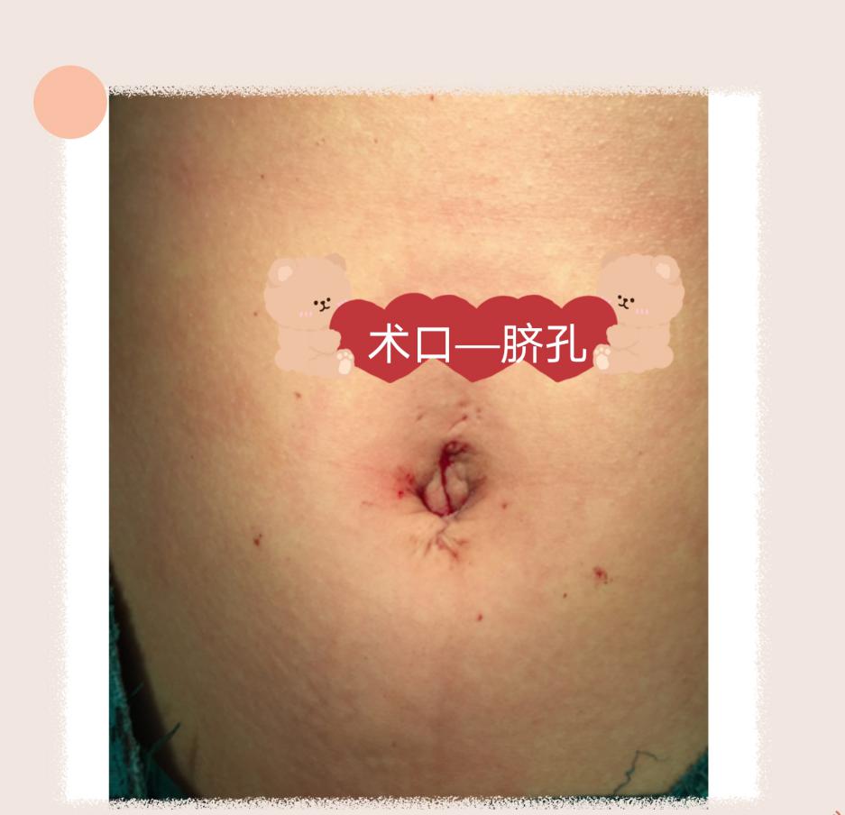 怀孕卵巢囊肿蒂扭转孩子能保住吗,怀孕卵巢囊肿扭转手术怎么做