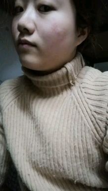 陈金西细胞种植可靠吗,陈金西细胞再生技术疤痕修复