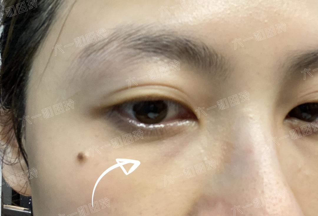 带娃长期熬夜的眼袋怎么去除,女人35岁以后一熬夜眼袋深怎么办