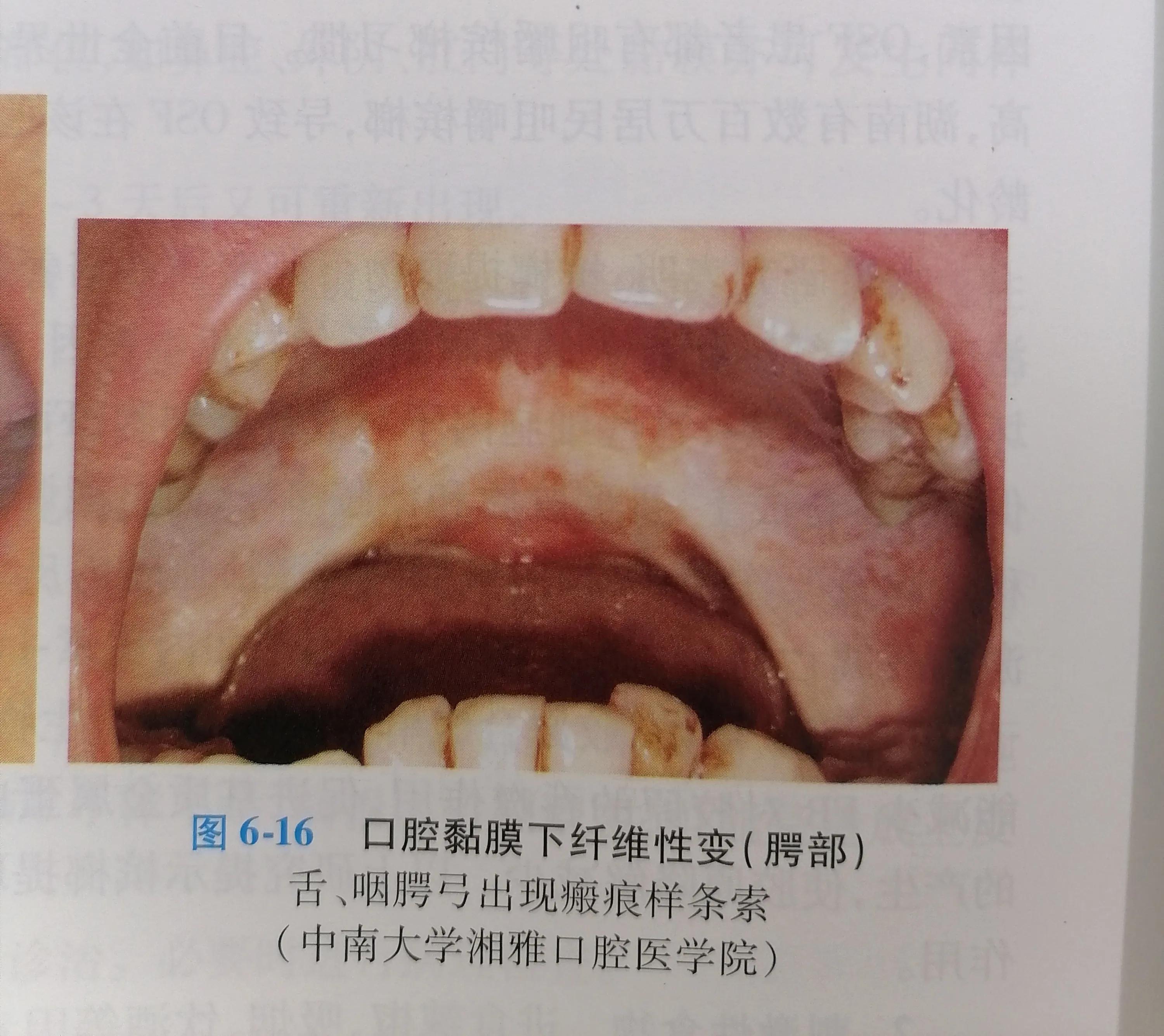 还在嚼槟榔吗,你嚼过槟榔吗
