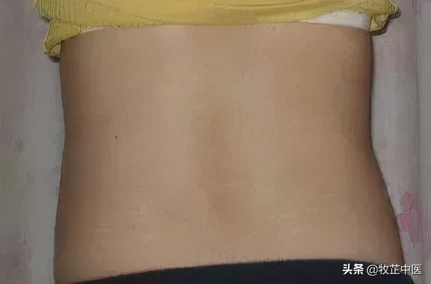 肾虚纹图片,肾虚纹真的有效果吗