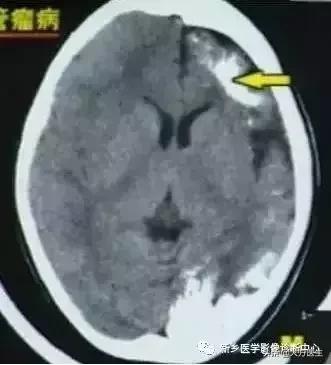 钙化灶是良性肿瘤的可能性大吗,颅内肿瘤钙化发生率最高