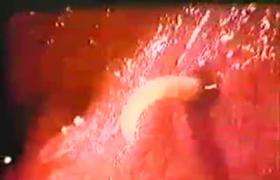 7岁男童肚子有蛔虫的表现,7岁男童肚子里蛔虫