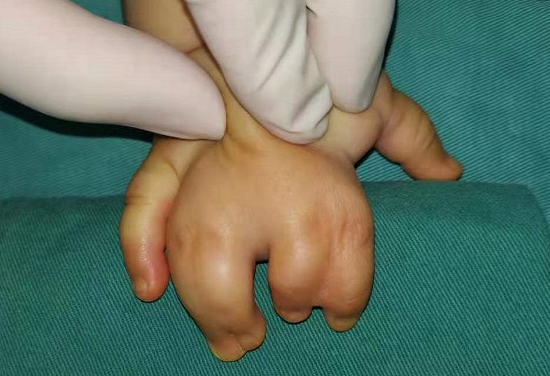 并指畸形免植皮案例,并指畸形