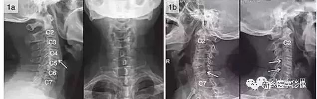 肘关节x线解剖,颈椎x线图片与讲解大全