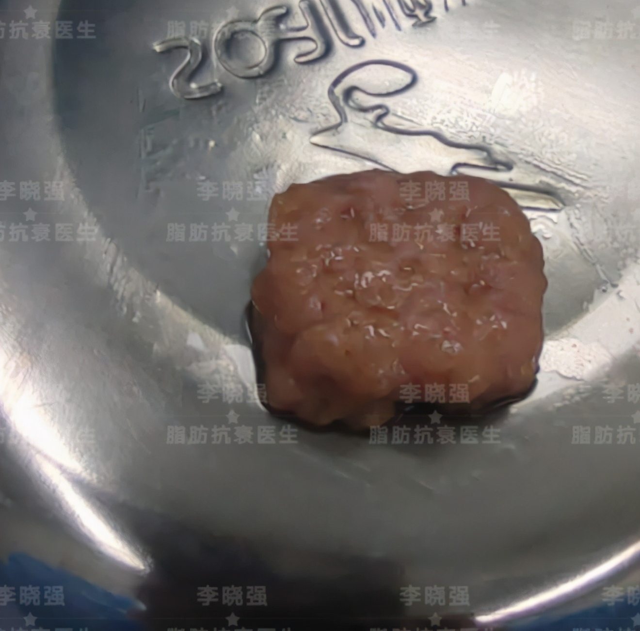 千万不要做减重手术,千万不要做自体脂肪填充