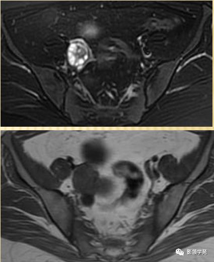 宫颈癌mri诊断,宫颈癌的mr扫描技术
