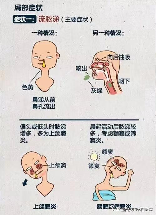 儿子鼻塞流脓鼻涕是鼻窦炎吗,孩子鼻窦炎流脓鼻涕伴有咳嗽