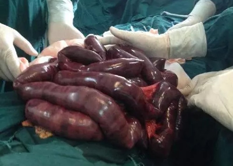 宫颈癌晚期不拉屎多久会死,如果孩子30天不拉屎会死吗