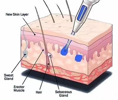 忍得住纹身的疼痛却忍不住想你,纹身忍疼的方法