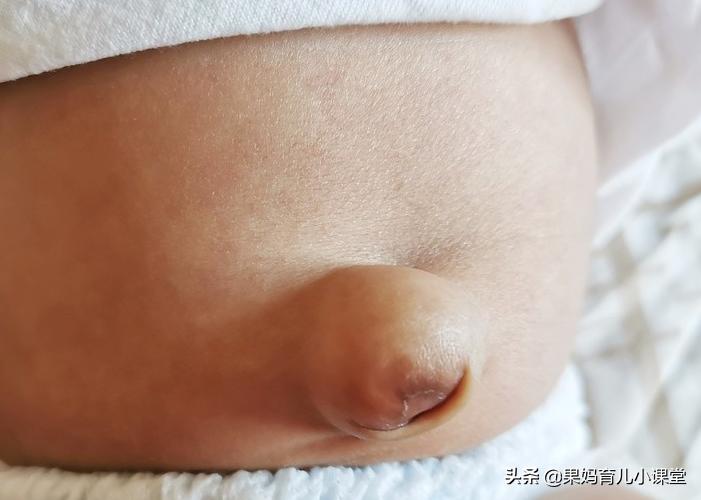 宝宝脐疝怎么处理好得快,宝宝脐疝要怎么处理