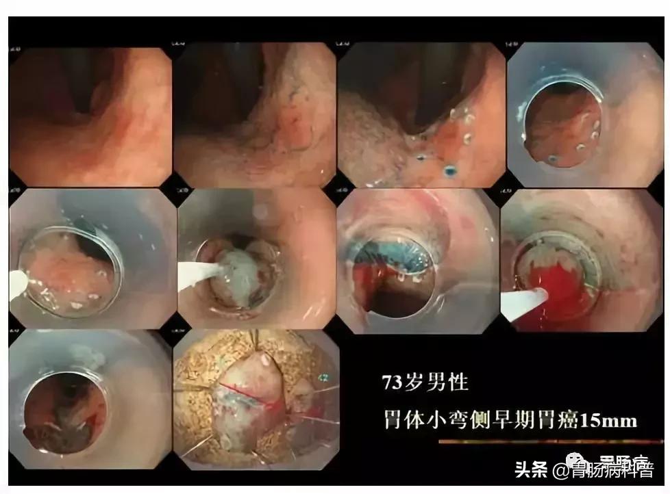 内镜下粘膜剥离术属于esd还是emr,胃肠息肉内镜下黏膜剥离术