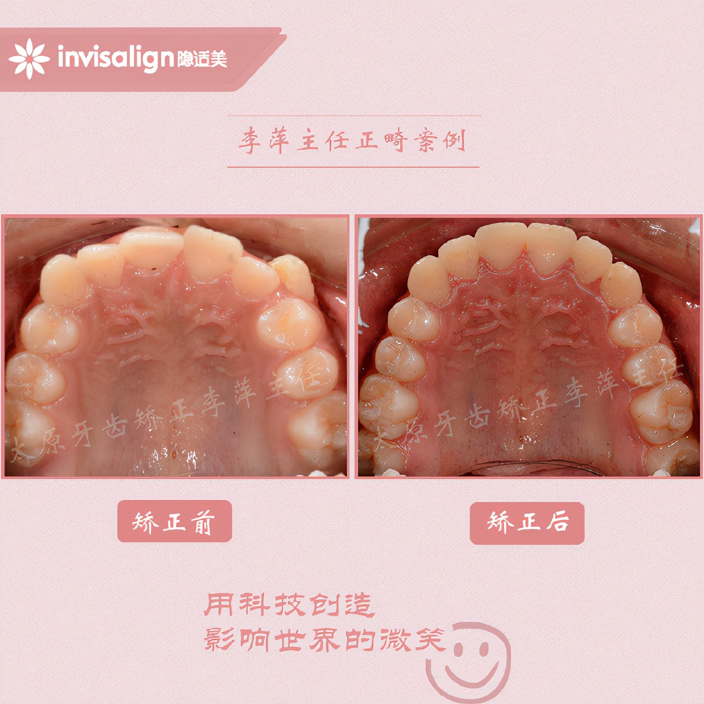 山西太原牙齿矫正医院十大排名,太原市牙齿矫正成功案