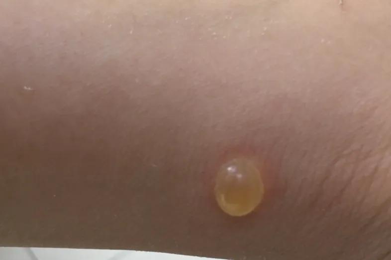 皮肤科专家支招如何应对虫咬皮炎,虫咬性皮炎几个不典型的皮肤症状