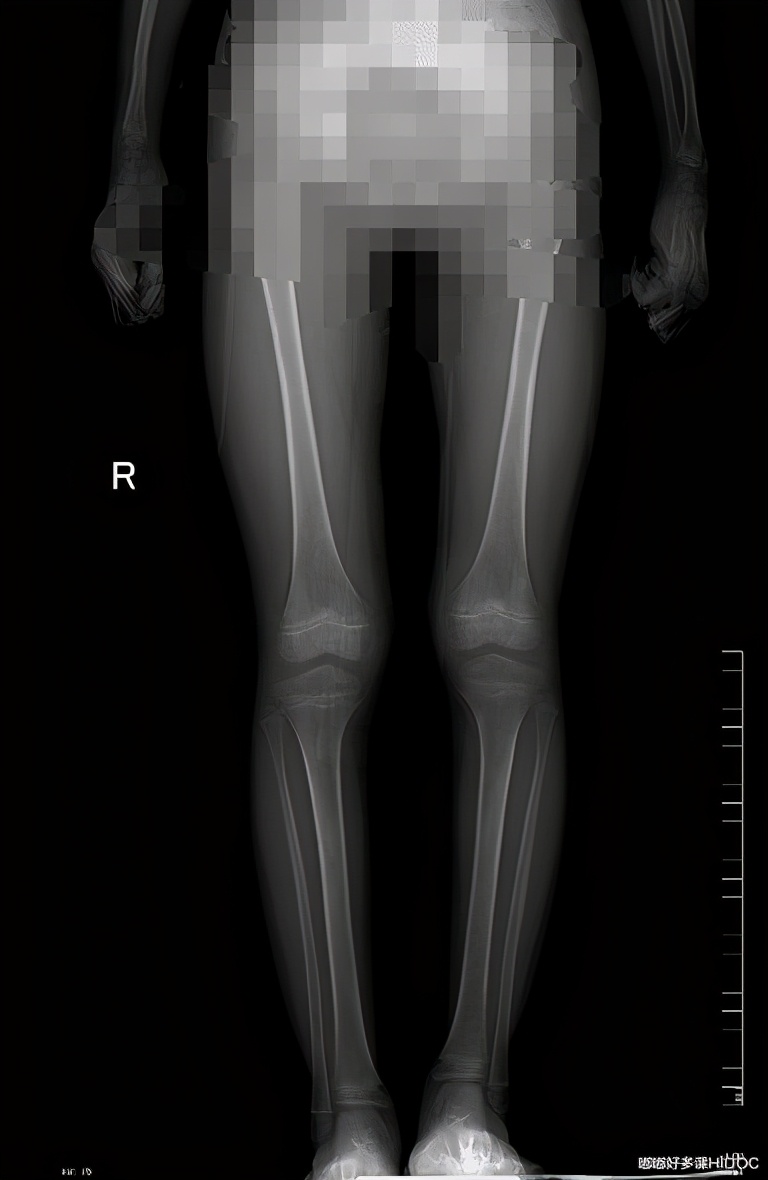 儿童颈椎侧弯会有什么后果,13岁孩子颈椎侧弯矫正睡姿图片