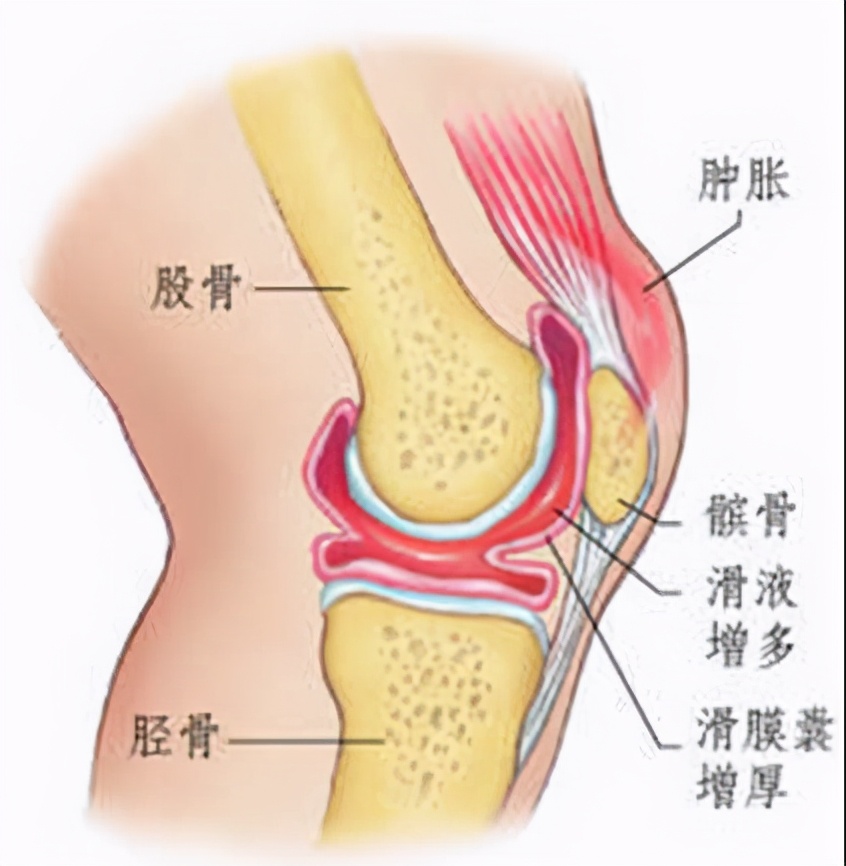 膝关节红肿疼痛,膝关节红肿发热疼痛