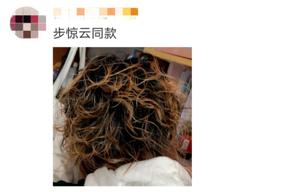 被发质问题困扰,被头发困扰20多年