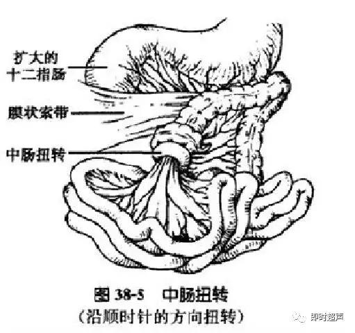 小儿消化道急症超声