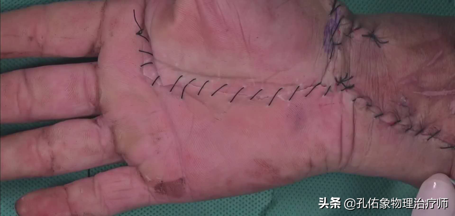 手指麻木是三大疾病前兆,手指麻木疼痛怎么治疗最好