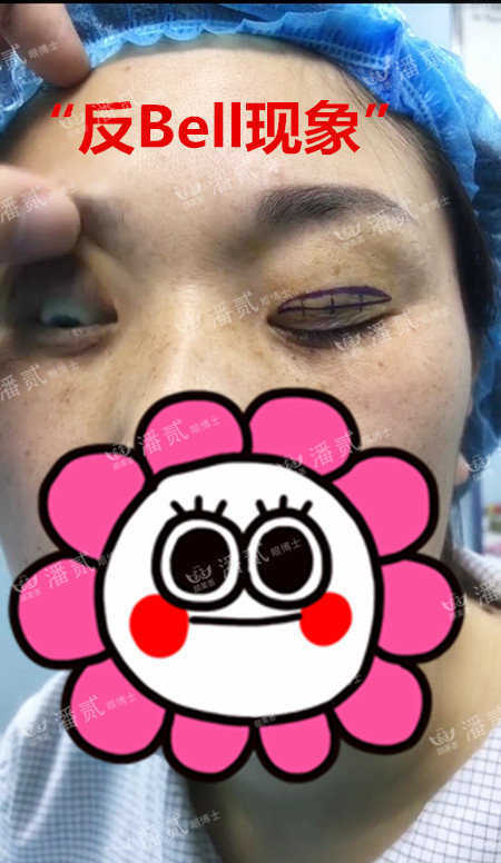 重度上睑下垂术后为什么闭不上眼睛？闭眼不全怎么护理好？