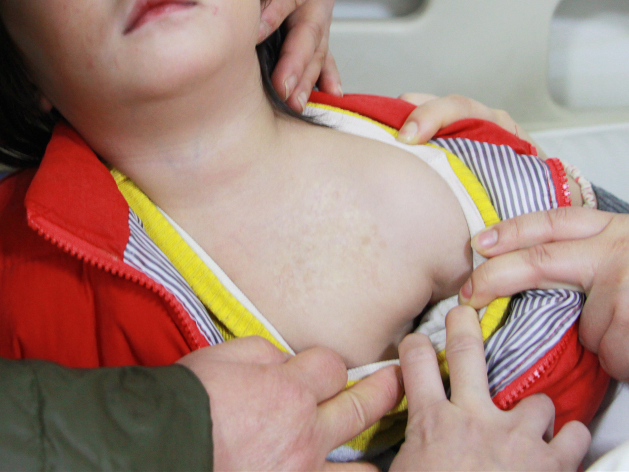 2岁女儿血管瘤,2岁小女孩肝血管瘤