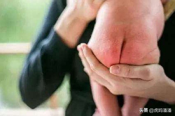 宝宝老是红屁屁用爽身粉有用吗,宝宝经常红屁屁用什么药膏