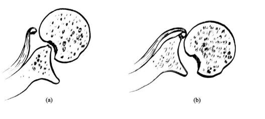 习惯性肩关节脱位怎么办,怎么检查肩关节是不是习惯性脱位