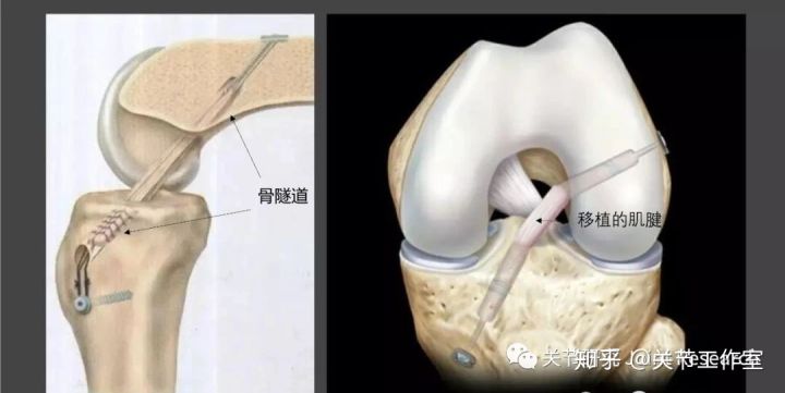 前交叉韧带断裂为什么没评上伤残,前交叉韧带断裂有什么症状