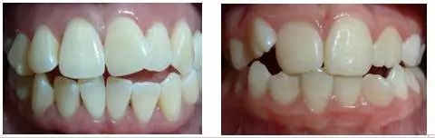 4岁舌系带过短要不要剪,什么是舌系带短图片