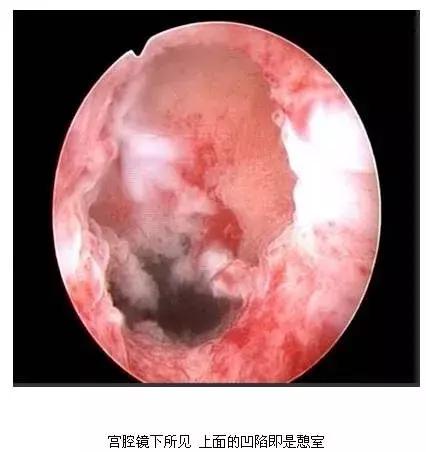 子宫憩室后遗症有哪些,子宫憩室手术治疗有哪些危害