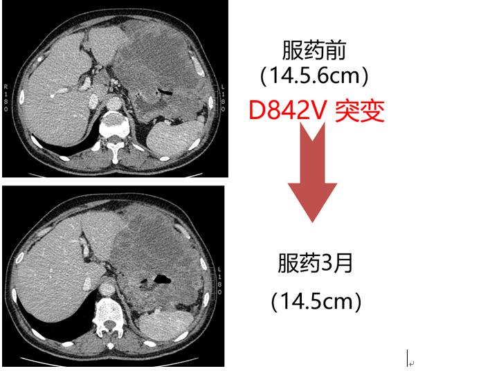 基因靶向治疗癌症靠谱吗,癌症基因检测靶向治疗什么意思