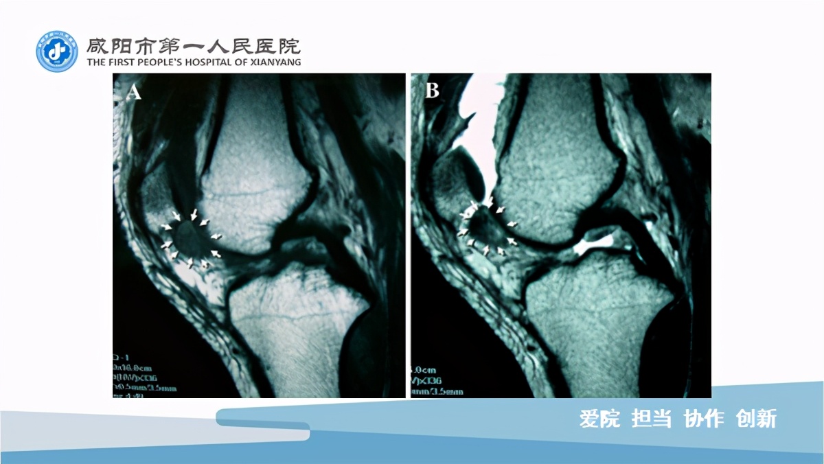 臭氧玻璃酸钠治疗膝关节炎怎么样,膝关节滑膜炎臭氧