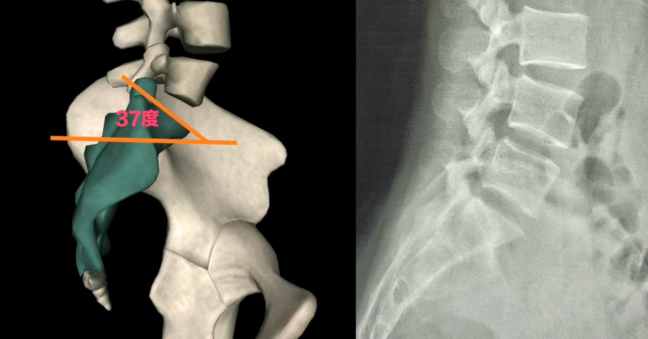 正骨矫正骨盆视频,正骨整脊矫正视频教程