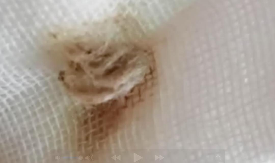 孩子停止发育一直流血,两个多月女婴下阴出血是怎么回事