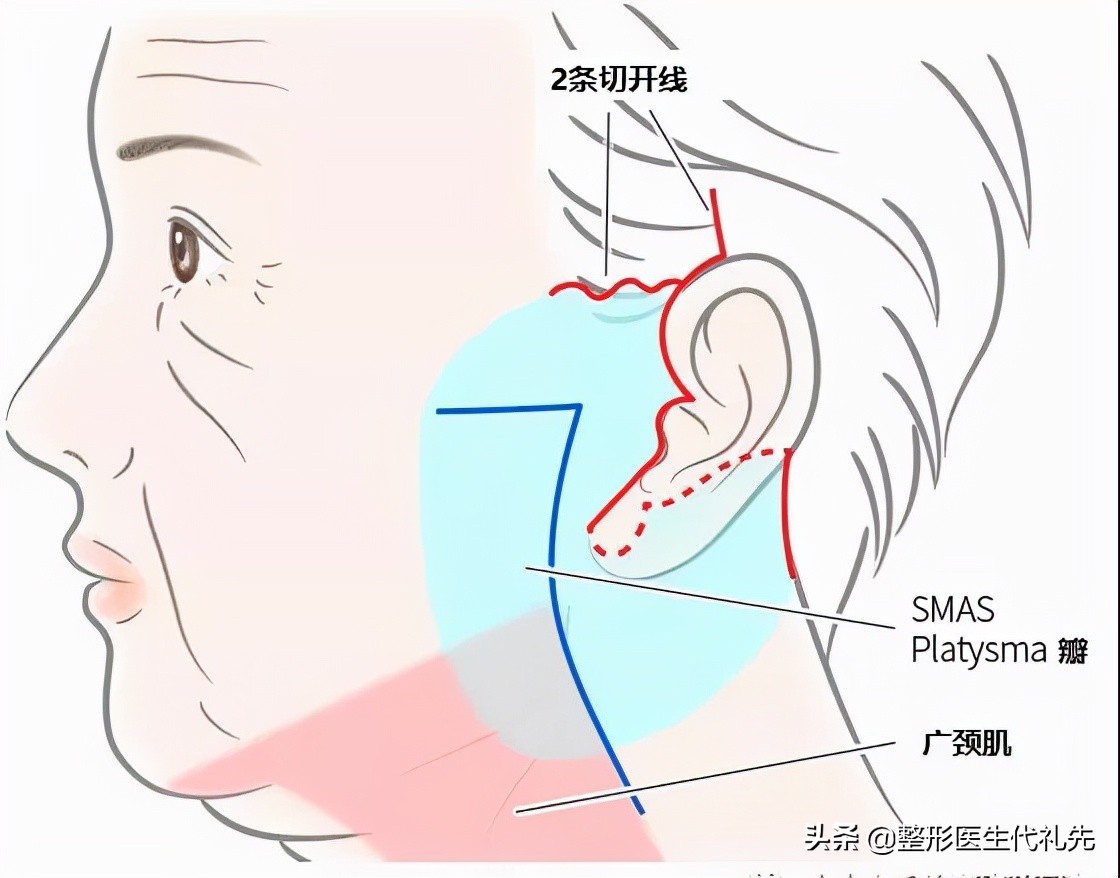 拉皮贴神器去法令纹有用吗,拉皮手术可以去除法令纹
