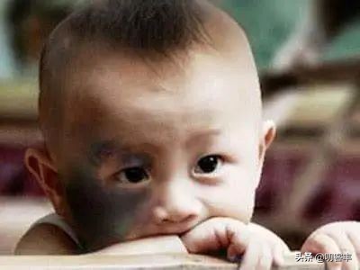 什么是太田痣黑褐色,什么是太田痣医生终于讲清楚了