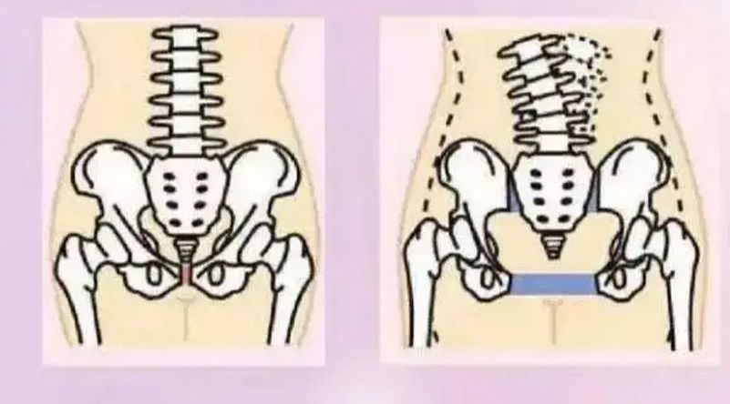 骨盆修复手法是不是智商税,做骨盆修复到底是不是智商税