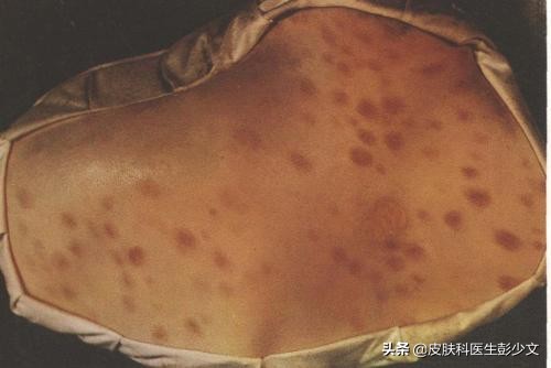 痘疮怎么治疗最快啊,身体长痘长疮怎么办最快消除