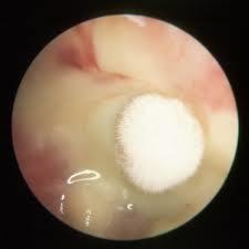 耳朵穿孔流脓能一直用抗生素吗,中耳炎辟谣