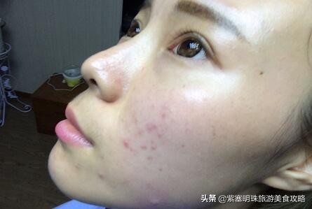 脸上起密密麻麻的小疙瘩怎么护理,脸上起了密密麻麻的小疙瘩怎么办