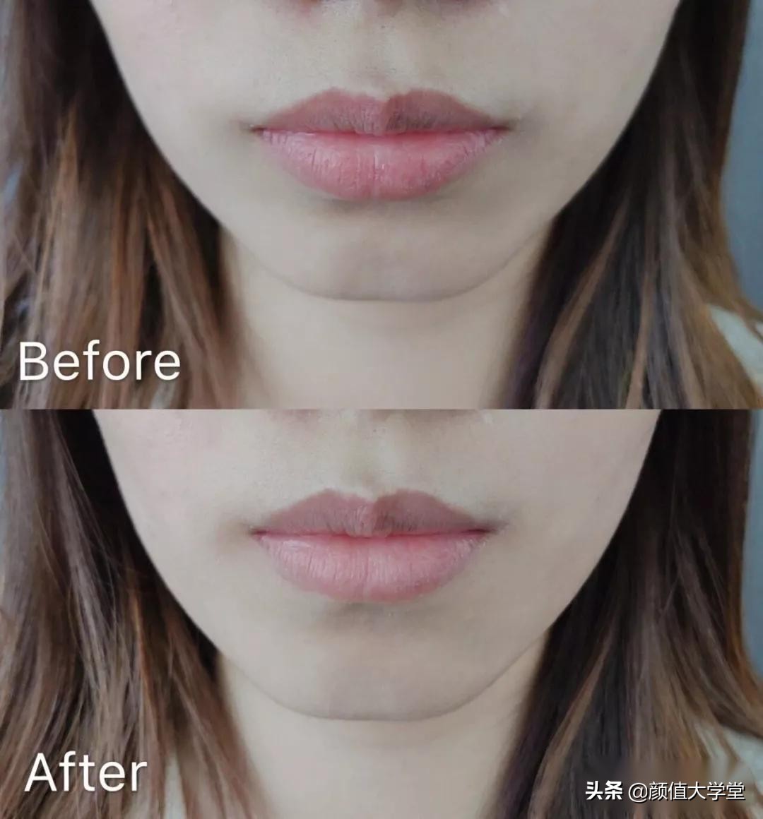 下巴后缩怎么拍侧颜,下巴后缩需要怎么矫正