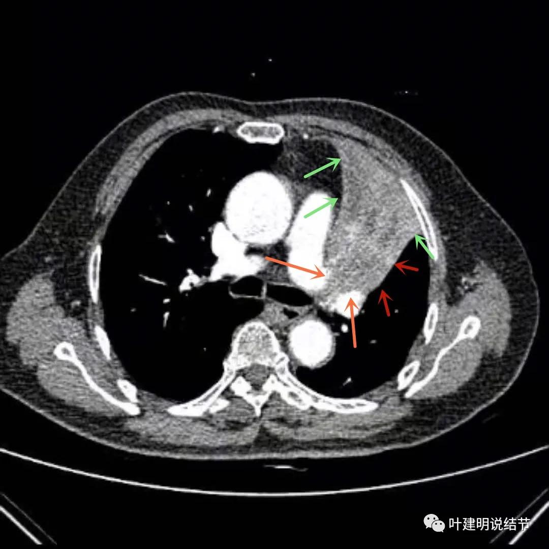 高龄肺癌靶向治疗效果,高龄老人肺癌早期适合放疗吗