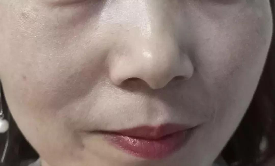 冬季护肤之祛斑正当时——光电治疗