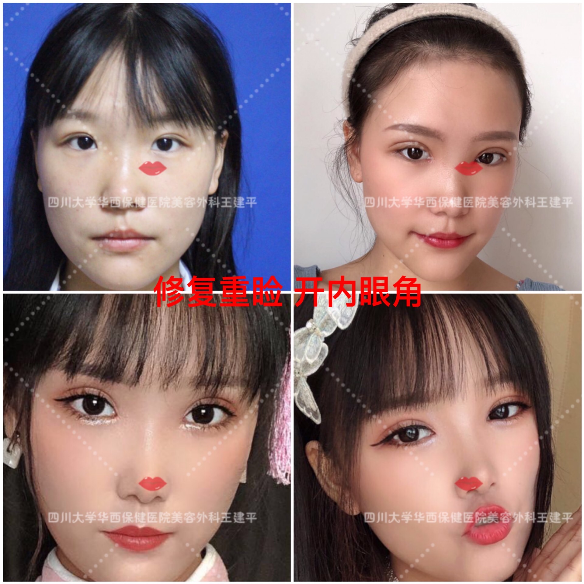 双眼皮有几种类型适合哪些脸型,各种类型的双眼皮适合啥样的人做